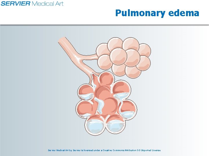 Pulmonary edema Servier Medical Art by Servier is licensed under a Creative Commons Attribution