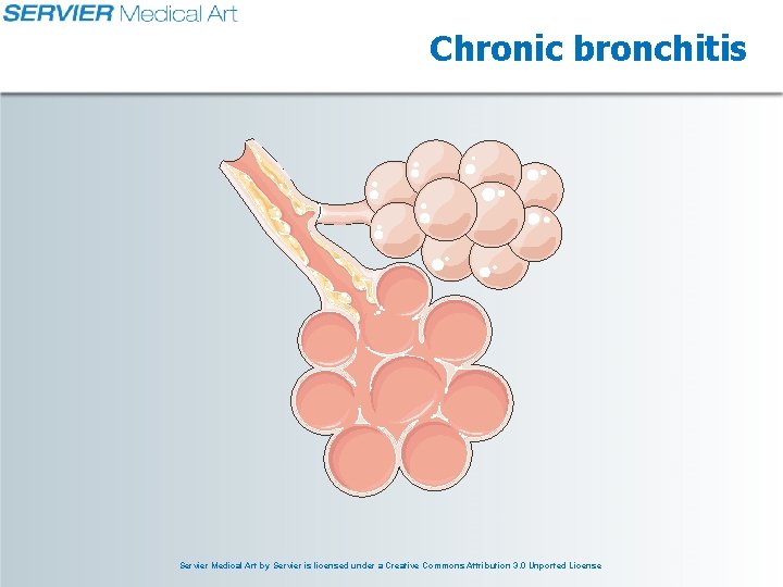 Chronic bronchitis Servier Medical Art by Servier is licensed under a Creative Commons Attribution