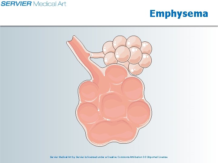 Emphysema Servier Medical Art by Servier is licensed under a Creative Commons Attribution 3.