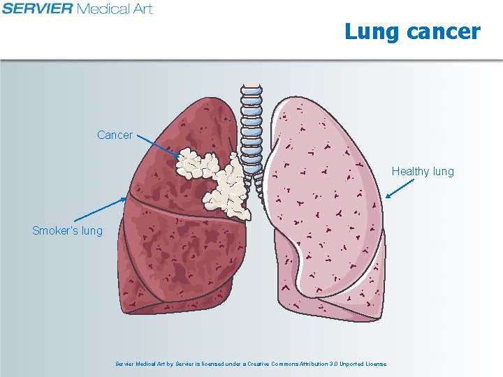 Lung cancer Cancer Healthy lung Smoker’s lung Servier Medical Art by Servier is licensed