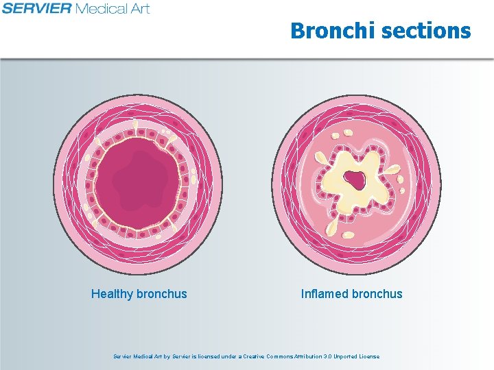 Bronchi sections Healthy bronchus Inflamed bronchus Servier Medical Art by Servier is licensed under