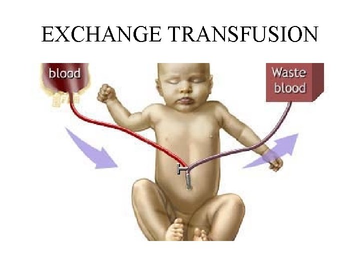 EXCHANGE TRANSFUSION 