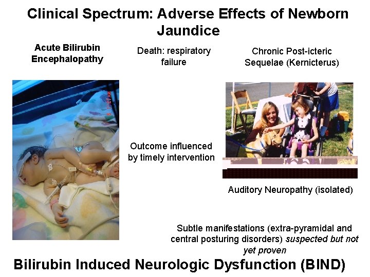 Clinical Spectrum: Adverse Effects of Newborn Jaundice Acute Bilirubin Encephalopathy Death: respiratory failure Chronic