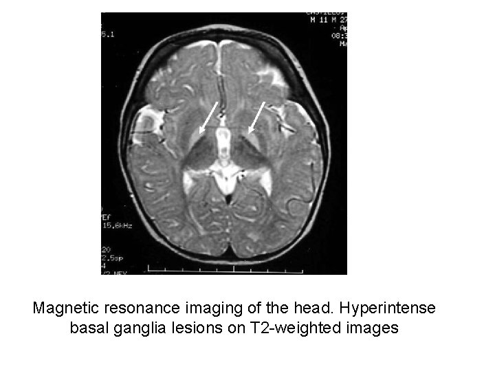 Magnetic resonance imaging of the head. Hyperintense basal ganglia lesions on T 2 -weighted