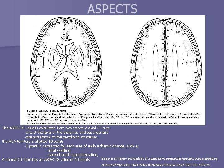 ASPECTS The ASPECTS value is calculated from two standard axial CT cuts: -one at