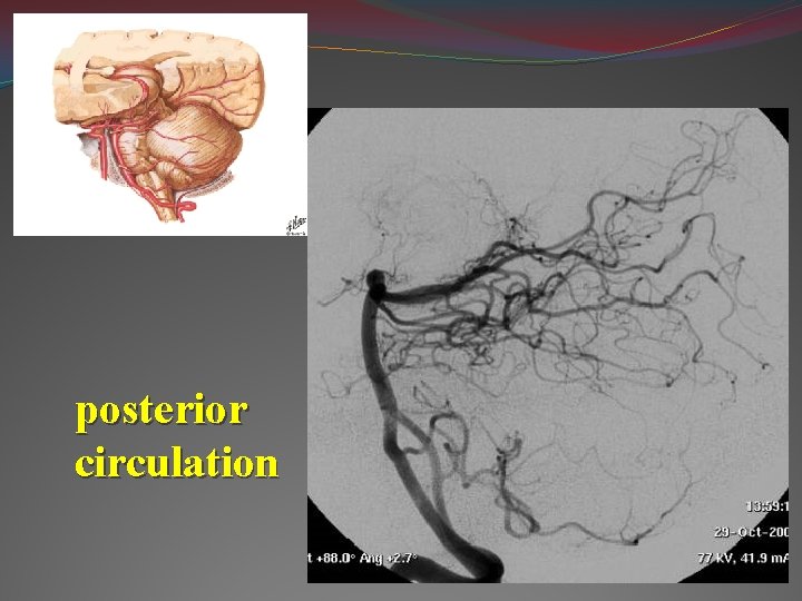 posterior circulation 