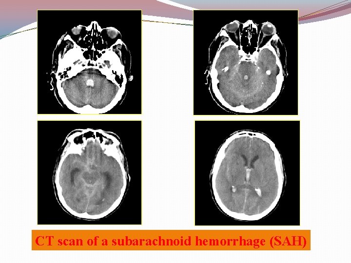 CT scan of a subarachnoid hemorrhage (SAH) 