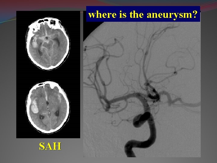 where is the aneurysm? SAH 