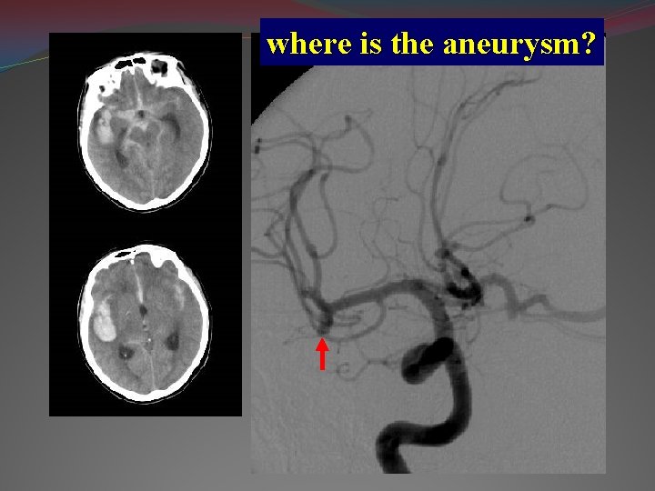 where is the aneurysm? 