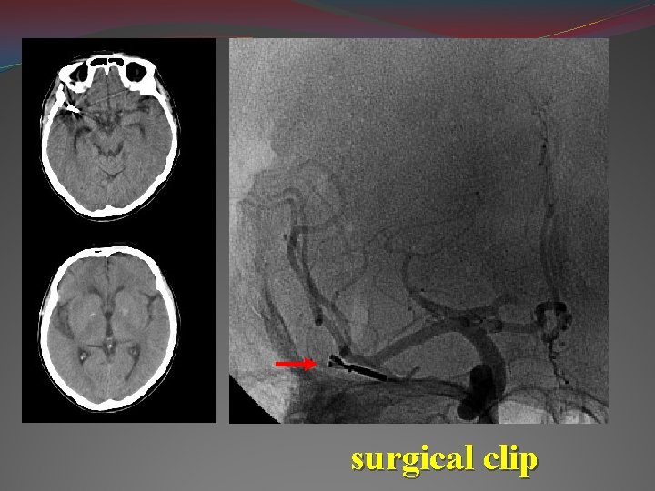 surgical clip 