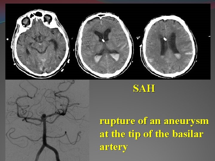 SAH rupture of an aneurysm at the tip of the basilar artery 