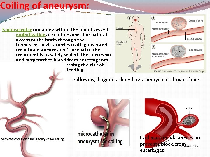 Coiling of aneurysm: Endovascular (meaning within the blood vessel) embolization, or coiling, uses the