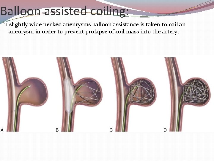 Balloon assisted coiling: In slightly wide necked aneurysms balloon assistance is taken to coil