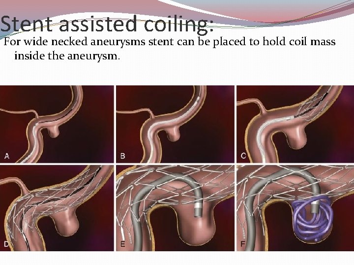 Stent assisted coiling: For wide necked aneurysms stent can be placed to hold coil