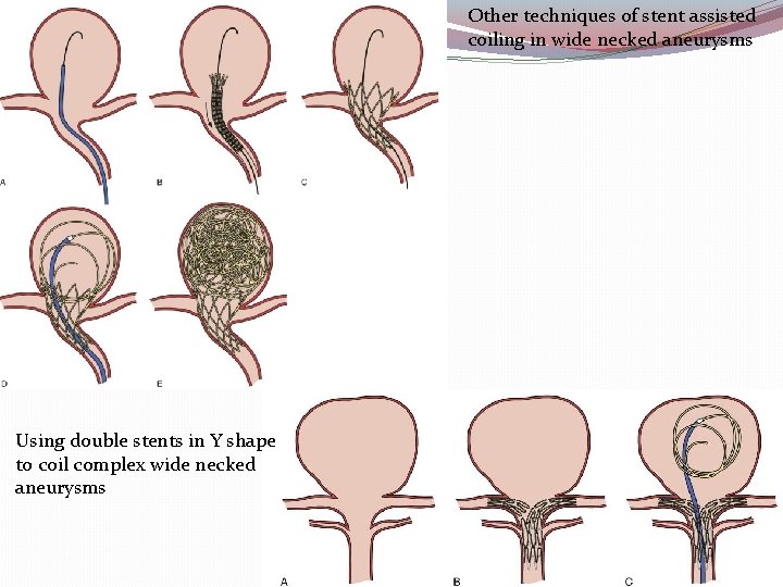 Other techniques of stent assisted coiling in wide necked aneurysms Using double stents in
