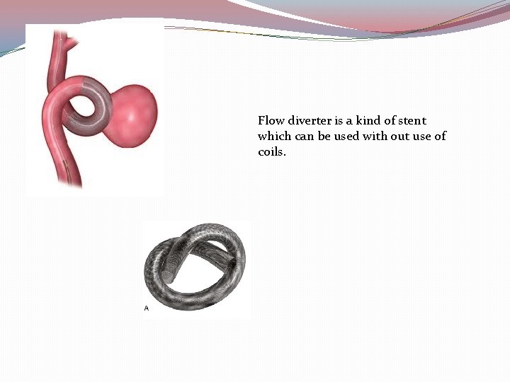 Flow diverter is a kind of stent which can be used with out use