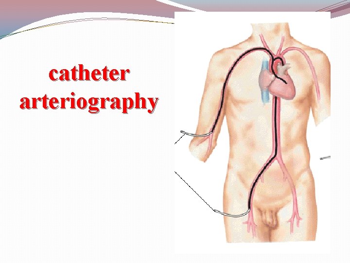 catheter arteriography 