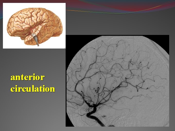 anterior circulation 