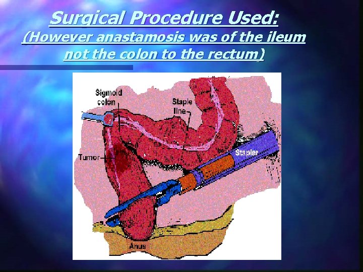 Surgical Procedure Used: (However anastamosis was of the ileum not the colon to the