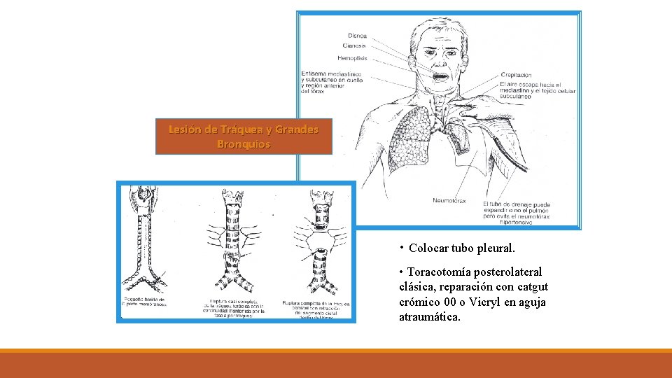 Lesión de Tráquea y Grandes Bronquios • Colocar tubo pleural. • Toracotomía posterolateral clásica,