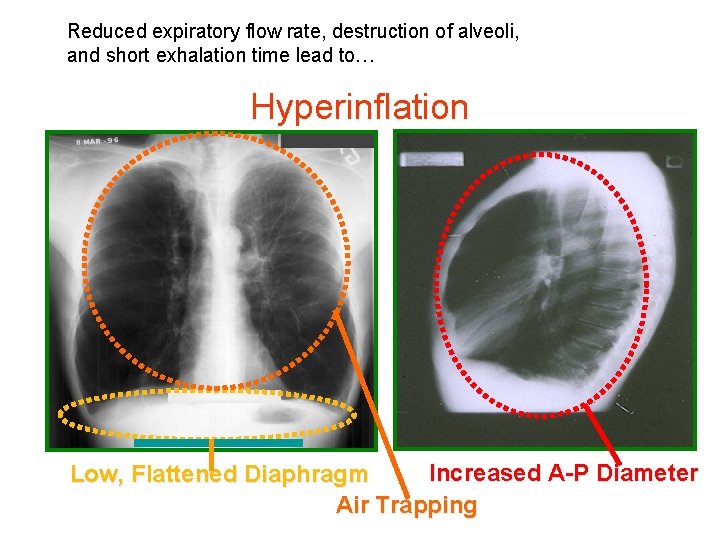 Reduced expiratory flow rate, destruction of alveoli, and short exhalation time lead to… Hyperinflation