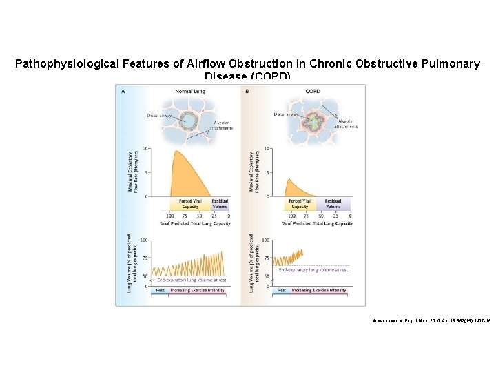 Pathophysiological Features of Airflow Obstruction in Chronic Obstructive Pulmonary Disease (COPD) Niewoehner. N Engl