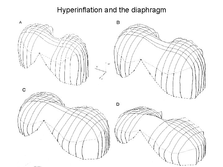 Hyperinflation and the diaphragm 
