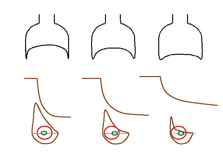 Limitación de flujo y de Volumen. 