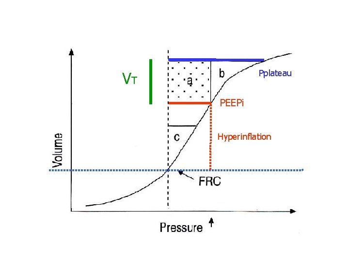 Pplateau VT PEEPi Hyperinflation 