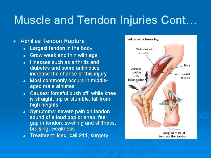 Muscle and Tendon Injuries Cont… Ø Achilles Tendon Rupture l l l l Largest