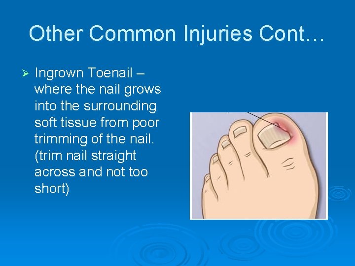 Other Common Injuries Cont… Ø Ingrown Toenail – where the nail grows into the