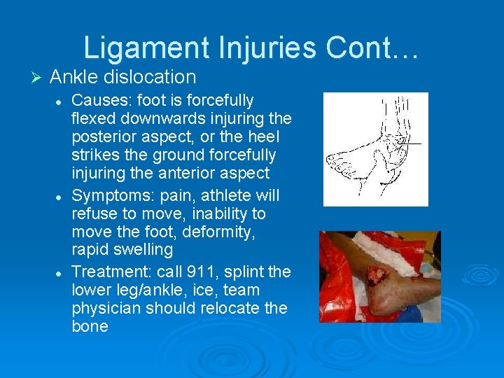 Ligament Injuries Cont… Ø Ankle dislocation l l l Causes: foot is forcefully flexed