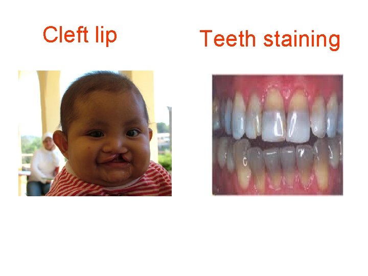 Cleft lip Teeth staining 