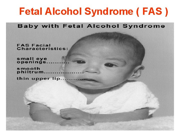 Fetal Alcohol Syndrome ( FAS ) 