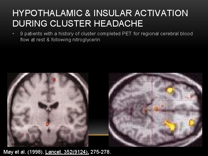 HYPOTHALAMIC & INSULAR ACTIVATION DURING CLUSTER HEADACHE • 9 patients with a history of