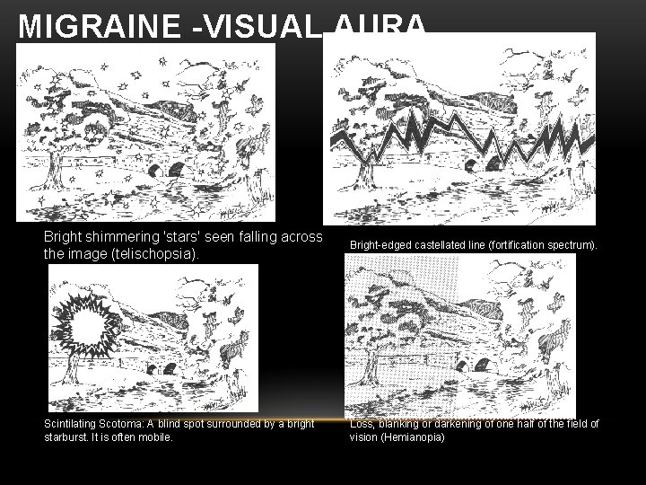 MIGRAINE -VISUAL AURA Bright shimmering 'stars' seen falling across the image (telischopsia). Scintilating Scotoma: