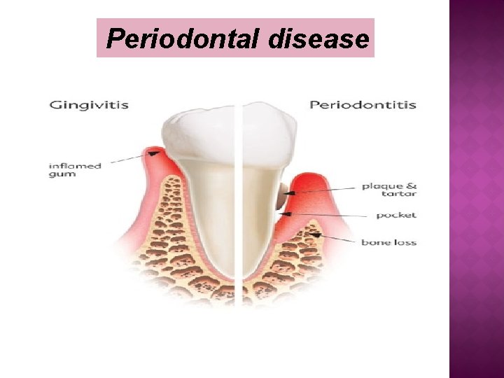 Periodontal disease 