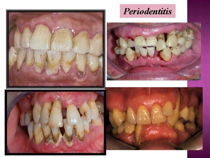 Periodentitis 