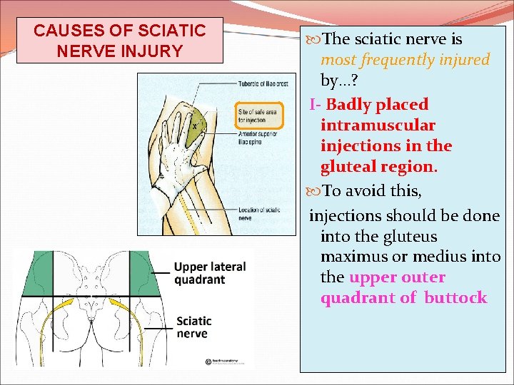 CAUSES OF SCIATIC NERVE INJURY The sciatic nerve is most frequently injured by…? I-