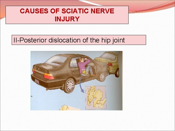 CAUSES OF SCIATIC NERVE INJURY II-Posterior dislocation of the hip joint 