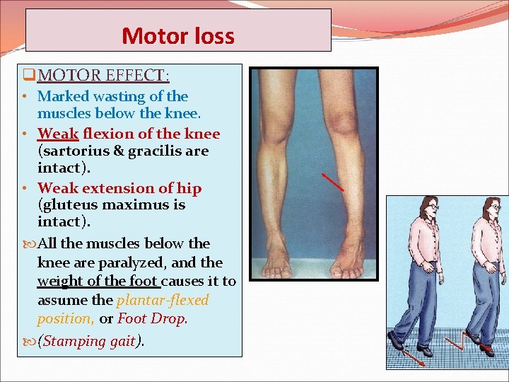 Motor loss q MOTOR EFFECT: • Marked wasting of the muscles below the knee.
