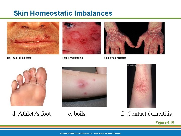 Skin Homeostatic Imbalances d. Athlete's foot e. boils f. Contact dermatitis Figure 4. 10