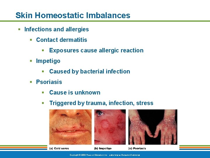 Skin Homeostatic Imbalances § Infections and allergies § Contact dermatitis § Exposures cause allergic