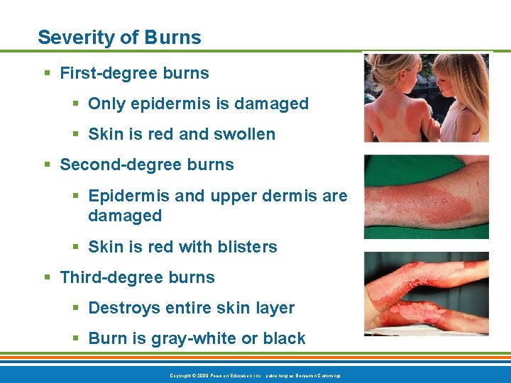 Severity of Burns § First-degree burns § Only epidermis is damaged § Skin is