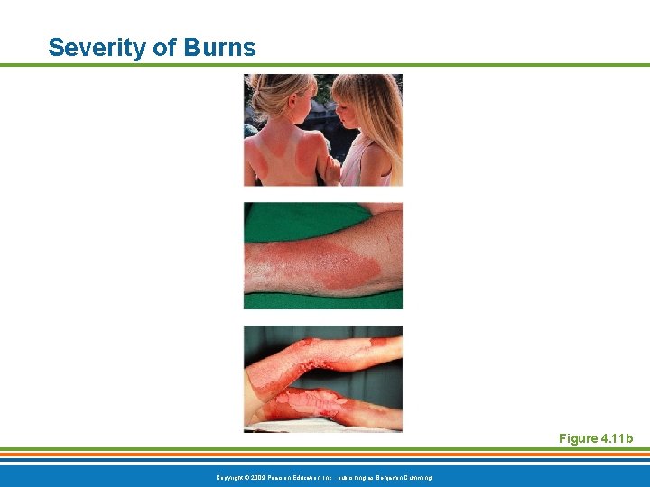 Severity of Burns Figure 4. 11 b Copyright © 2009 Pearson Education, Inc. ,