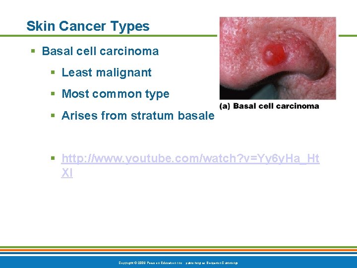 Skin Cancer Types § Basal cell carcinoma § Least malignant § Most common type