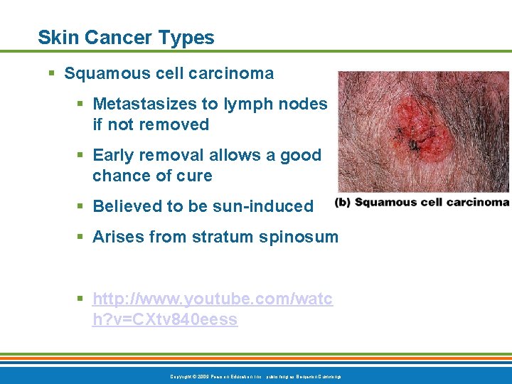 Skin Cancer Types § Squamous cell carcinoma § Metastasizes to lymph nodes if not