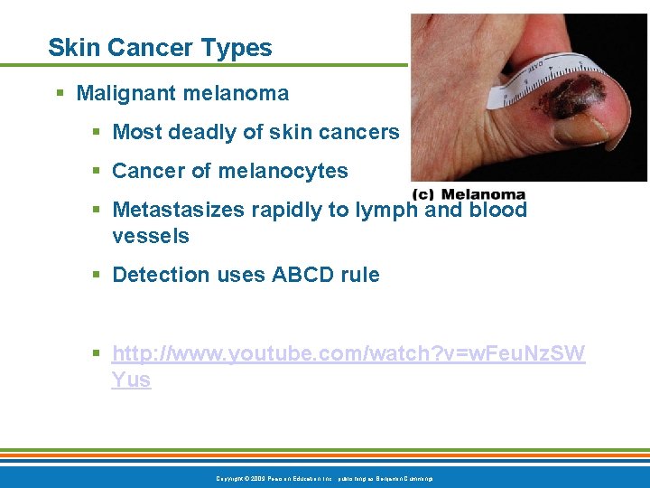 Skin Cancer Types § Malignant melanoma § Most deadly of skin cancers § Cancer