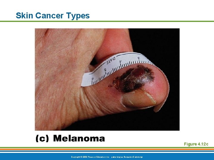 Skin Cancer Types Figure 4. 12 c Copyright © 2009 Pearson Education, Inc. ,