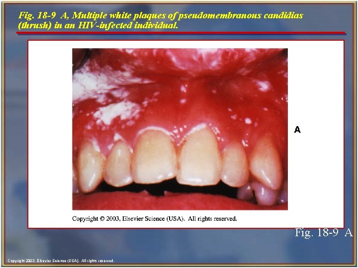 Fig. 18 -9 A, Multiple white plaques of pseudomembranous candidias (thrush) in an HIV-infected